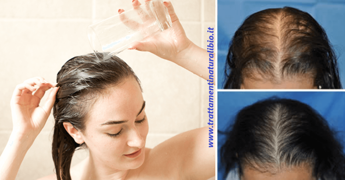 L’ingrediente che blocca la caduta dei capelli, e li fa ricrescere L’ingrediente che blocca la caduta dei capelli, e li fa ricrescere in 2 settimane