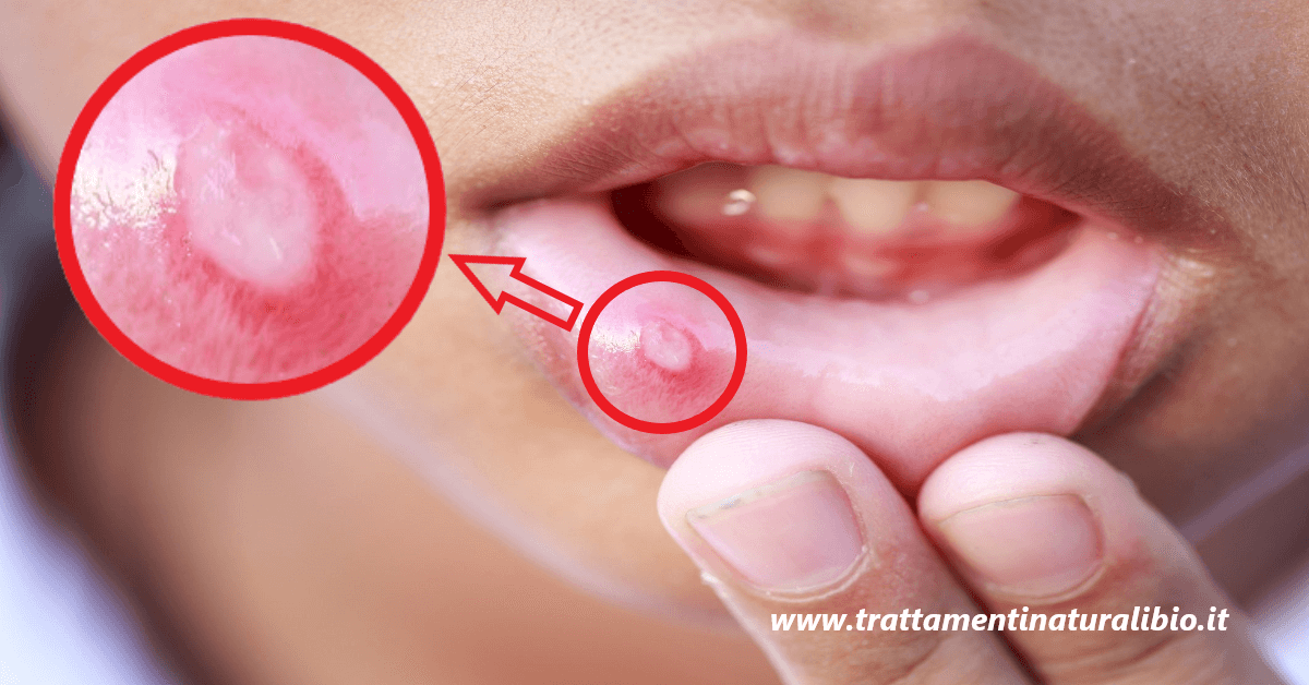 Un’afta in bocca può essere sintomo di una di queste 6 condizioni