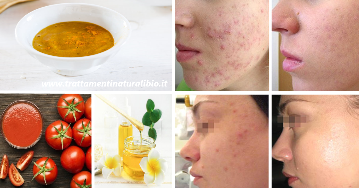 6 trattamenti naturali per avere una pelle libera da imperfezioni, senza rughe, macchie o acne 6 trattamenti naturali per avere una pelle libera da imperfezioni, senza rughe, macchie o acne
