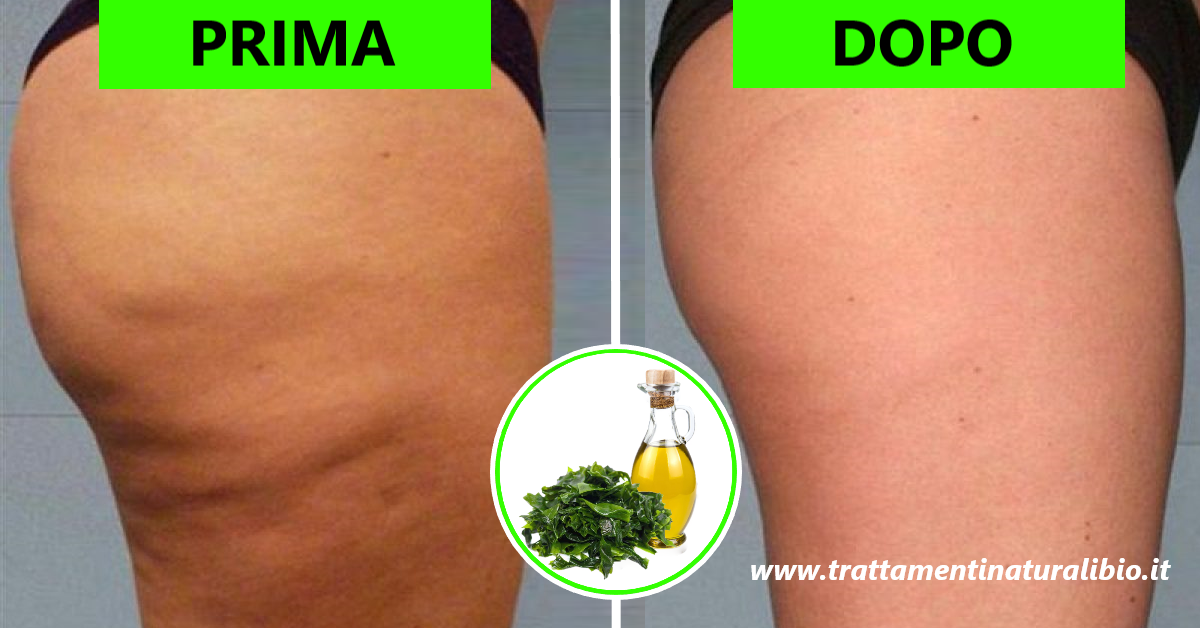 L’olio naturale che elimina la cellulite in pochissimi giorni L’olio naturale che elimina la cellulite in pochissimi giorni