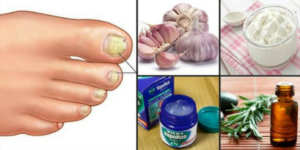 Come eliminare i funghi delle unghie per sempre e in modo naturale