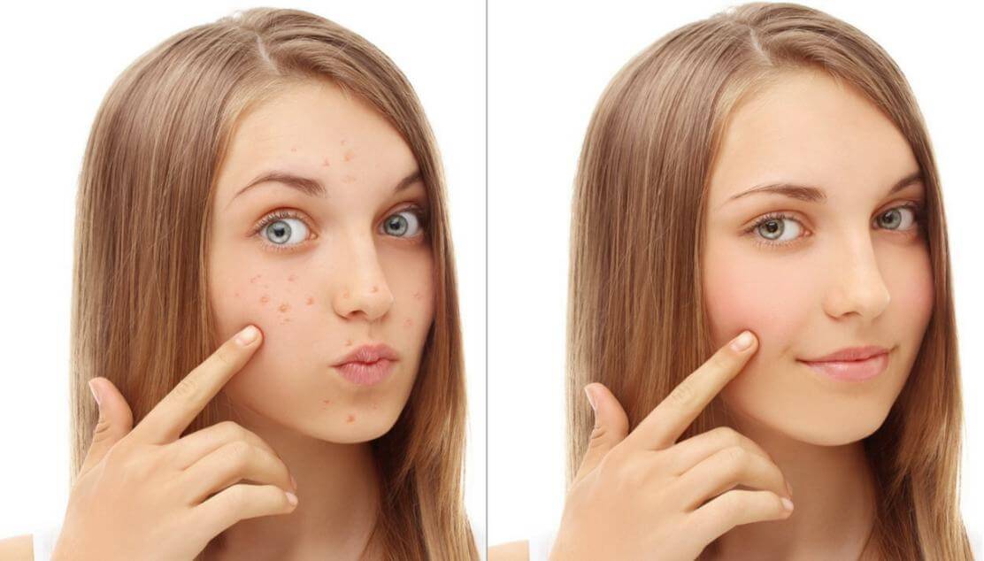 Trattamenti 100% naturali contro l'acne ecco i più efficaci Trattamenti 100% naturali contro l'acne ecco i più efficaci