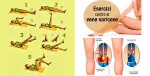 Elimina le vene varicose Elimina le vene varicose