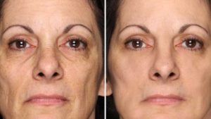 Fast Lifting crema viso antirughe: Funziona Fast Lifting crema viso antirughe: Funziona
