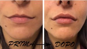 Natulips Rimpolpante labbra Natulips Rimpolpante labbra