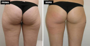 Natural Shape gel Anticellulite: Funziona Natural Shape gel Anticellulite: Funziona