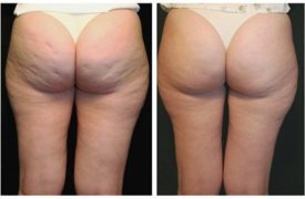 Rimedio Definitivo per eliminare la Cellulite già dalla prima settimana