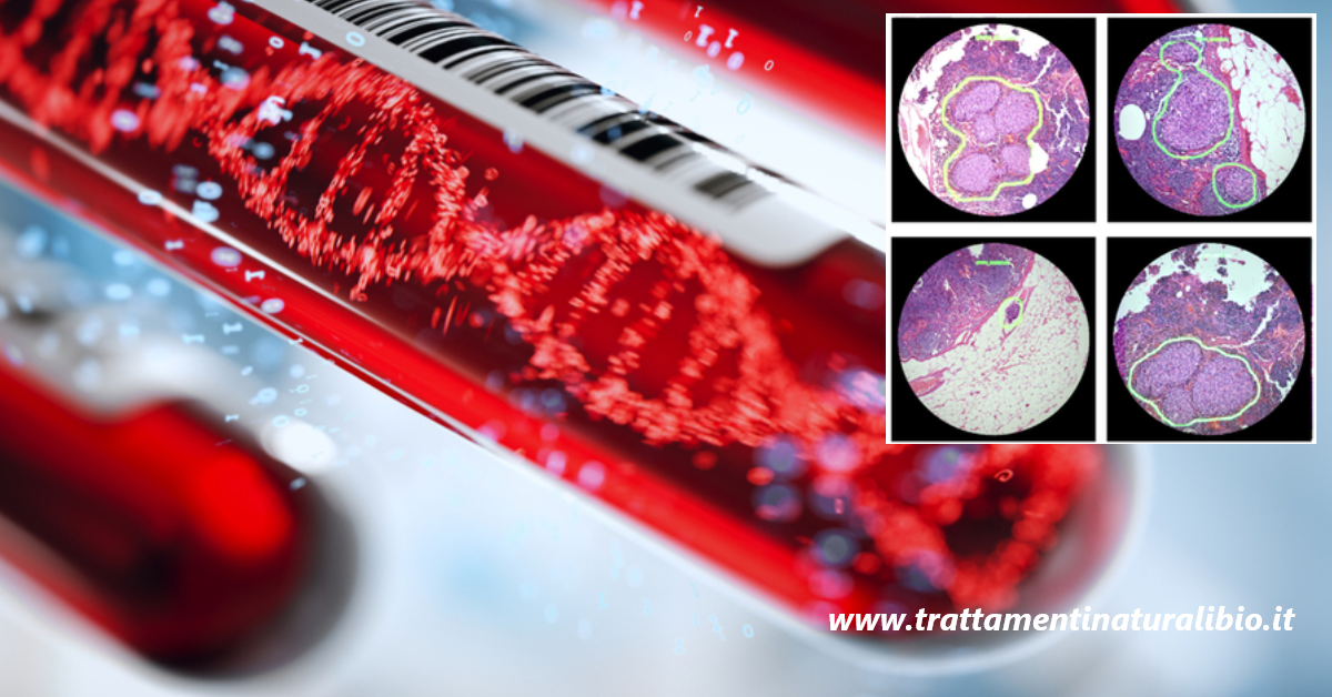 Rivoluzione nella diagnosi del Cancro, test del sangue rileva segni dei tumori prima che si manifestino Rivoluzione nella diagnosi del Cancro, test del sangue rileva segni dei tumori prima che si manifestino