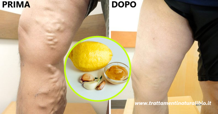 Come preparare la famosa crema all'aglio e limone contro le vene varicose Come preparare la famosa crema all'aglio e limone contro le vene varicose