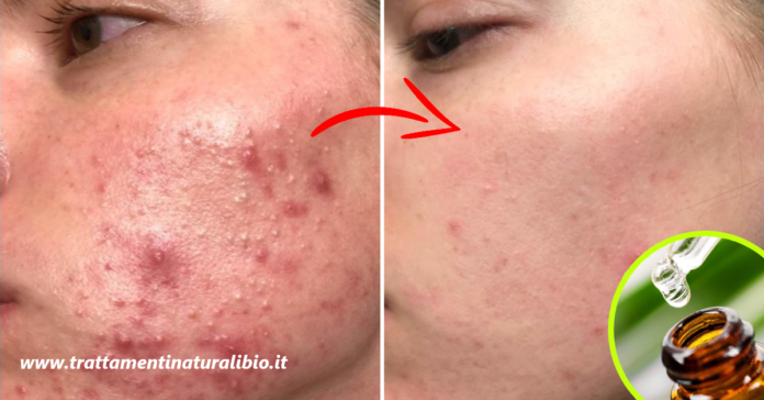 Come usare il tea tree oil per eliminare brufoli e acne in modo efficace