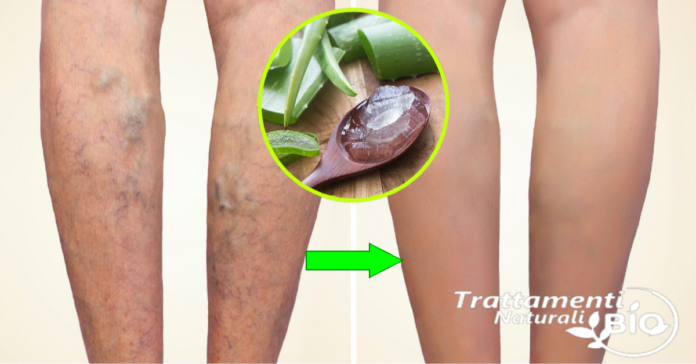Elimina le Vene Varicose in 5 giorni con questo Potente rimedio a base di Aloe Vera Elimina le Vene Varicose in 5 giorni con questo Potente rimedio a base di Aloe Vera